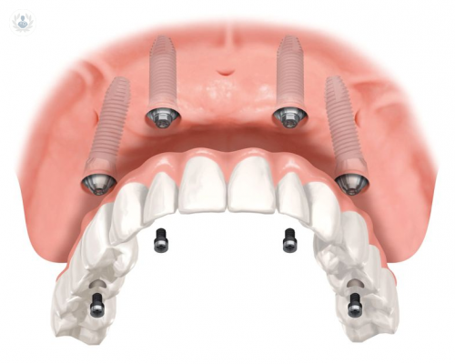 implantes-all-on-four-el-tratamiento-clave-para-pacientes-con-perdida-osea imagen de artículo