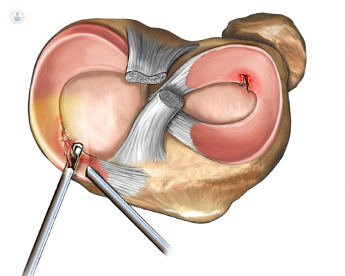 como-tratar-una-lesion-de-meniscos imagen de artículo