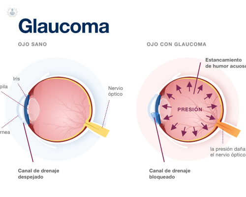 El Glaucoma no tiene cura