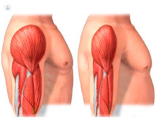 que-es-la-sarcopenia imagen de artículo