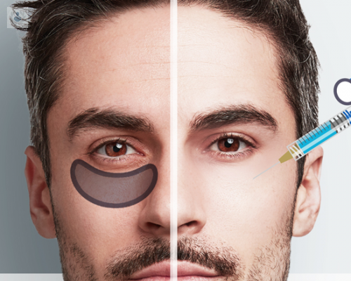 que-debo-hacer-para-eliminar-mis-ojeras imagen de artículo