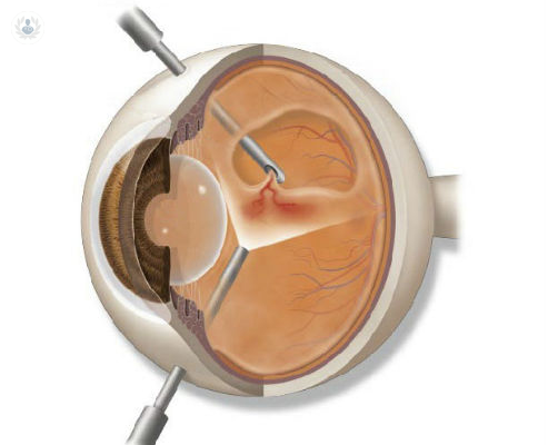 cirugia-del-vitreo-o-vitrectomia imagen de artículo