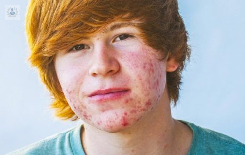como-podemos-eliminar-el-acne-juvenil-y-sus-cicatrices imagen de artículo