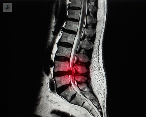 estenosis-de-canal-lumbar-caso-de-un-paciente imagen de artículo