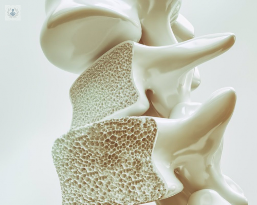 osteoporosis-su-relacion-con-el-cancer-diagnostico-y-tratamiento imagen de artículo