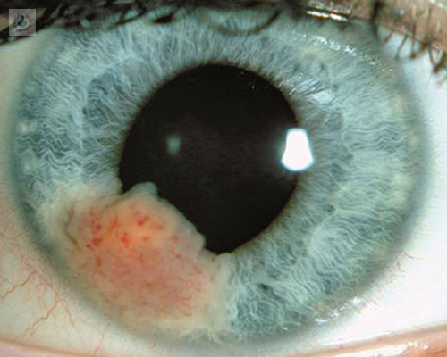 diferentes-tipos-de-tumores-oculares-y-sus-causas-y-sintomas imagen de artículo
