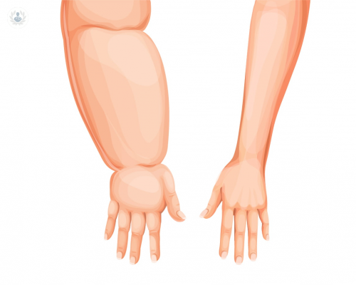 linfedema-como-se-producen-y-como-tratarlos imagen de artículo