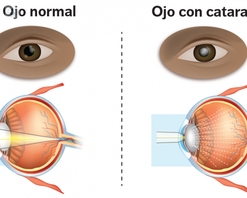 que-hacer-si-tengo-cataratas imagen de artículo