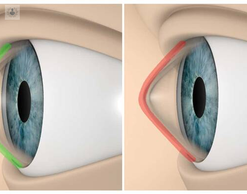 queratocono-la-patologia-de-los-ojos-en-forma-conica-e-irregular imagen de artículo