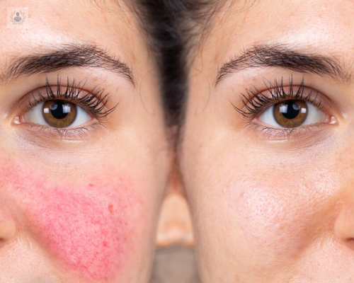 como-tratamos-el-rubor-facial imagen de artículo
