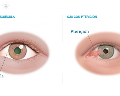 pinguecula-una-degeneracion-que-aparece-como-una-mancha-amarillenta imagen de artículo