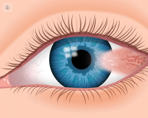 climas-secos-y-altas-temperaturas-favorecen-la-aparicion-del-pterigion imagen de artículo