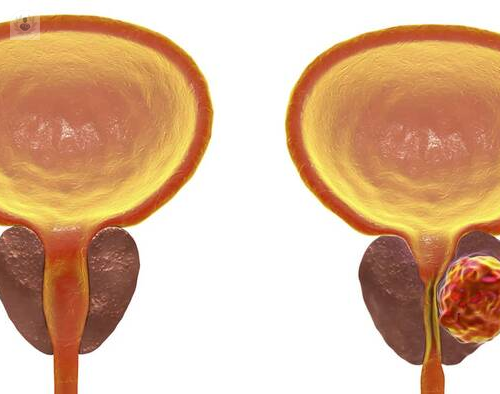 la-braquiterapia-aumenta-la-supervivencia-en-el-cancer-de-prostata imagen de artículo