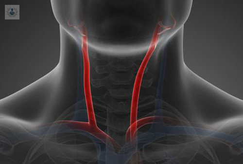 Arterias Carótidas: ¿cuándo se operan y en qué consiste la cirugía?