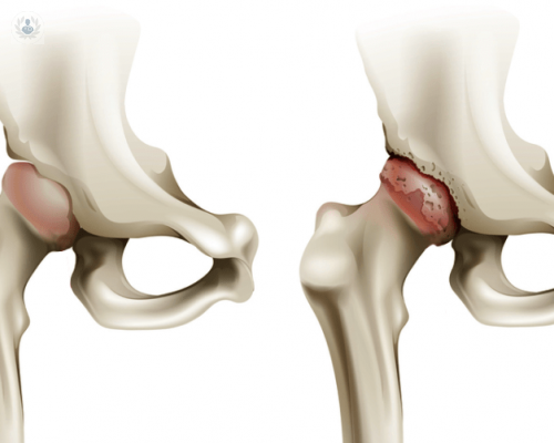 podemos-detectar-y-prevenir-la-artrosis-de-cadera imagen de artículo