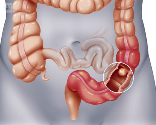 cancer-colorrectal-diagnostico-y-tratamiento imagen de artículo