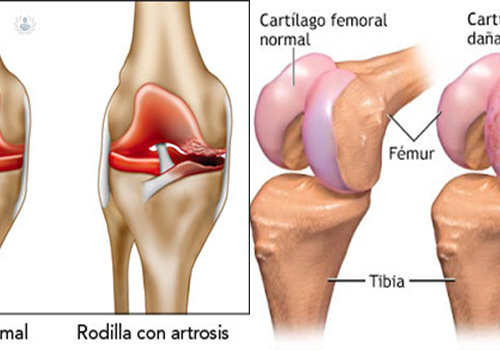 lo-mas-nuevo-en-la-cirugia-de-la-artrosis-de-rodilla imagen de artículo