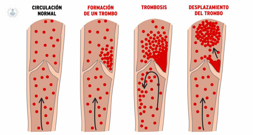 la-trombosis-y-la-embolia imagen de artículo