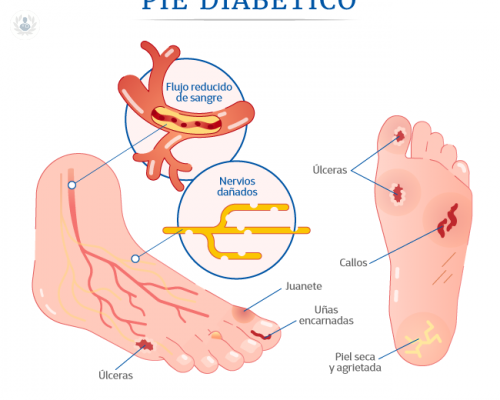 pie-diabetico-sintomas-causas-y-prevencion imagen de artículo