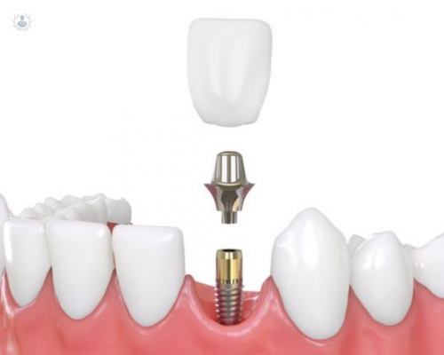 por-que-debo-escoger-implantes-de-carga-inmediata imagen de artículo