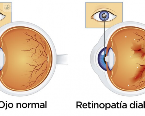 El ojo del paciente diabético: Retina y Cataratas