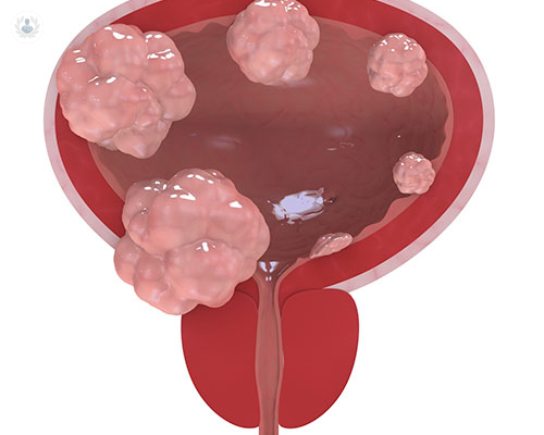 cancer-de-vejiga-deteccion-tratamiento-y-prevencion imagen de artículo