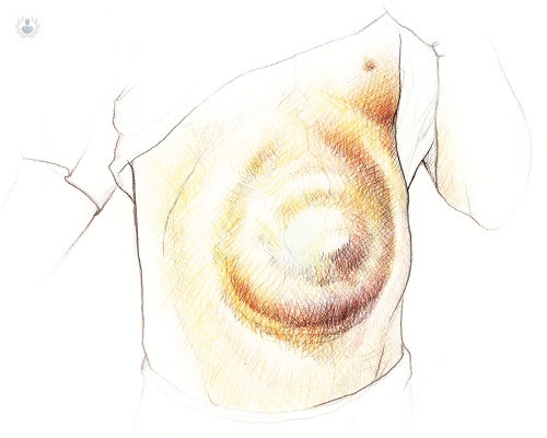 eventracion-causas-sintomas-y-tratamiento imagen de artículo