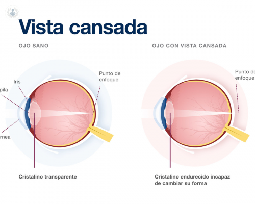 operacion-de-la-vista-cansada-indicaciones-procedimiento-y-postoperatorio imagen de artículo