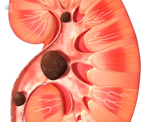 urolitiasis-causas-sintomas-y-tratamiento imagen de artículo