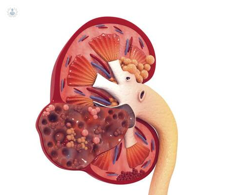 cancer-renal-diagnostico-y-tratamiento imagen de artículo