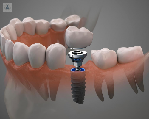 fases-para-el-tratamiento-de-los-implantes-dentales imagen de artículo