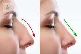Rinoplastia, la Cirugía que cambia el aspecto de tu nariz 