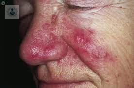 tengo-rosacea-como-puedo-tratarla imagen de artículo
