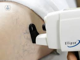 laser-de-nd-yag-para-el-tratamiento-de-varices-y-aranas-vasculares imagen de artículo