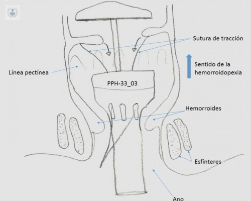 el-tratamiento-contra-las-hemorroides-la-mucosectomia-circular-mecanica-de-longo imagen de artículo