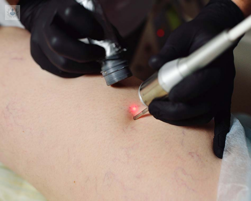 laser-vascular-usos-y-ventajas imagen de artículo