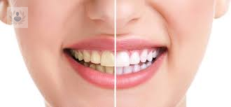 luce-una-dentadura-perfecta-con-el-blanqueamiento-dental imagen de artículo