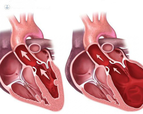 que-es-la-miocardiopatia-hipertrofica imagen de artículo