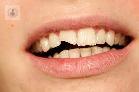 conoce-mas-a-cerca-de-los-traumatismos-dentales imagen de artículo