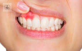 Enfermedades periodontales: la Gingivitis y la Periodontitis