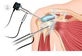 Artroscopía de Hombro: aplicaciones y proceso quirúrgico 