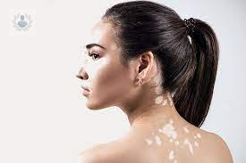 5-cuestiones-sobre-el-vitiligo imagen de artículo
