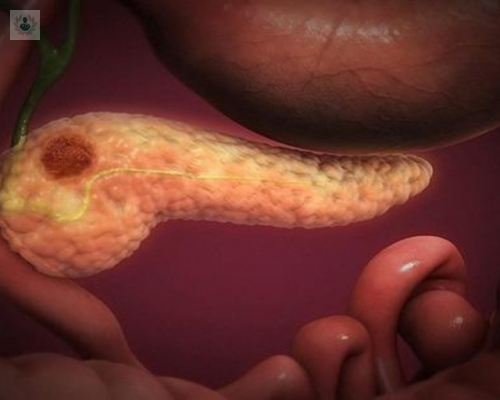 guia-del-cancer-de-pancreas imagen de artículo