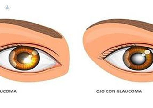 ¿Nos tiene que asustar la palabra Glaucoma?