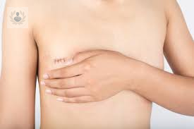 asimetria-mamaria imagen de artículo