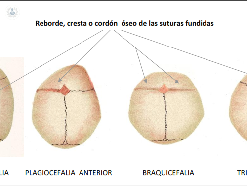 Craneosinostosis: Deformación Craneal por cierre precoz de una sutura
