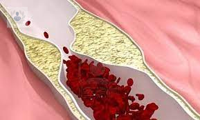 La Arteriosclerosis