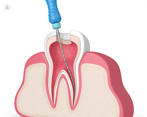 la-endodoncia-elimina-de-manera-definitiva-el-dolor-agudo imagen de artículo