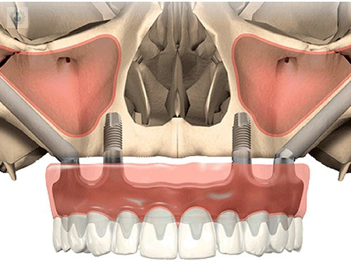 implantes-cigomaticos-solucion-a-la-ausencia-de-hueso-maxilar imagen de artículo