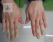Artritis Reumatoide: enfermedad de causa desconocida